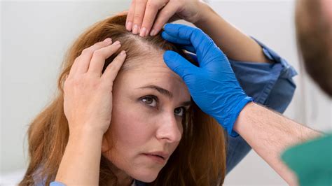 What Causes Female Androgenetic Alopecia Lyskin