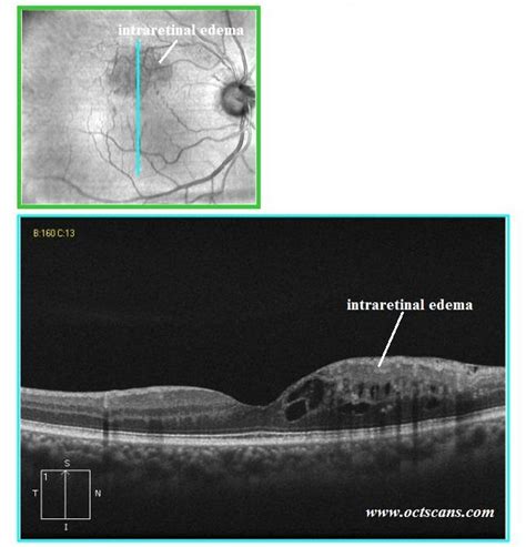 Branch Retinal Vein Occlusion