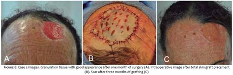 Surgical And Cosmetic Dermatology Surgical Management Of High Risk