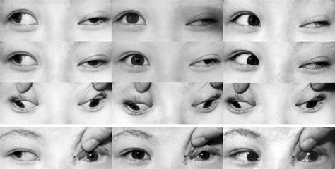 Surgical Management Of Large Angle Incomitant Strabismus In Patients