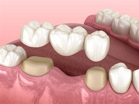 Dental Bridges Vs Implants Which Is Best For Missing Teeth