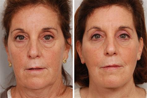 Blepharoplastie Prix