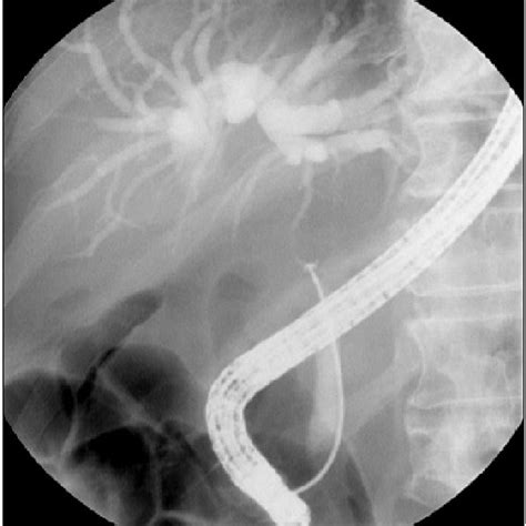 Endoscopic Retrograde Cholangiogram Reveals Malignant Stricture Of The