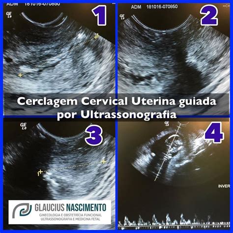 Procedimentos Cir Rgicos Guiados Por Ultrassonografia Dr Glaucius