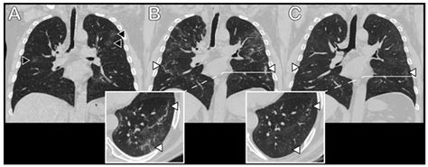 Medicina Free Full Text Follow Up Analysis Of Pulmonary Function