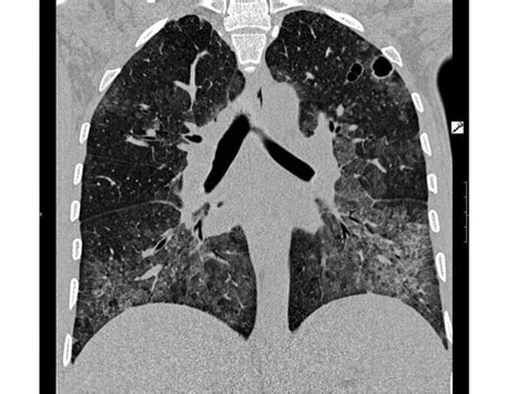 Pulmonary Pneumocystis Jiroveci Infection Pacs