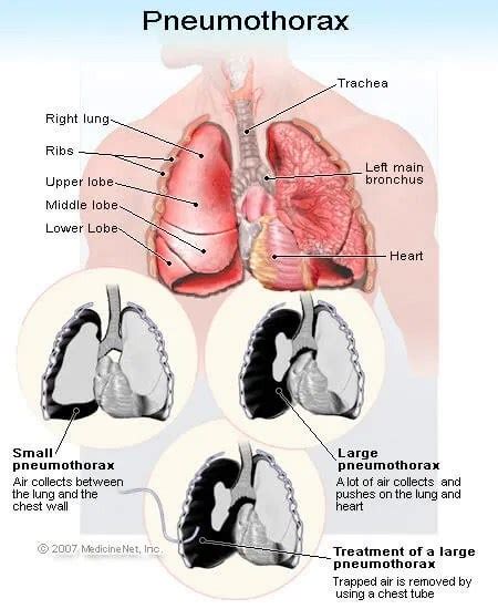 Types of Pneumothorax | Medically Speaking