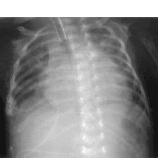 Preoperative Chest Posterioranterior Radiography Shows Marked