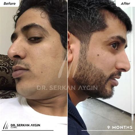 Beard Transplant In Turkey What Do You Need To Know Dr Serkan Aygin