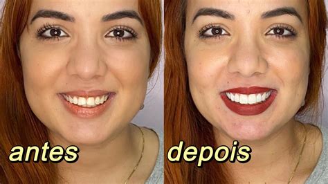 Rozex Antes E Depois BRAINCP