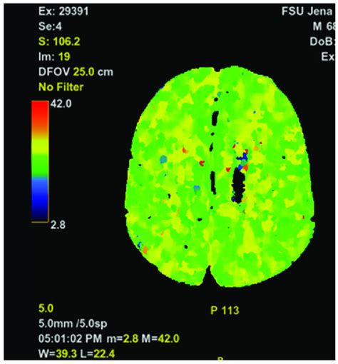 Representative Cerebral Perfusion Scan Slice Of The Head Imaging Study