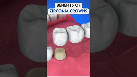 Unlock Your Perfect Smile Discover The Benefits Of Zirconia Crowns