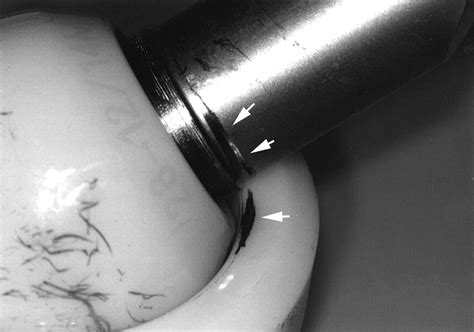 Mid Term Results Of Cementless Total Hip Replacement Using A Ceramic On Ceramic Bearing With And