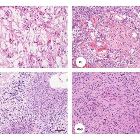 Representative Images Of Three Groups Of Meningiomas Corresponding To