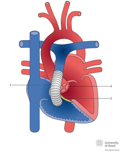 Truncus Arteriosus Cahal