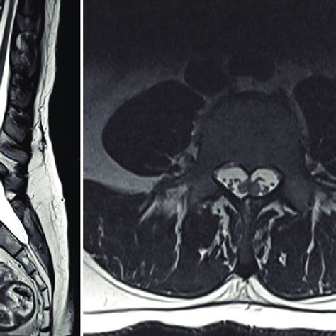 Preoperative Sagittal Left And Axial Right T2 Mri Of The Lumbar Download Scientific Diagram