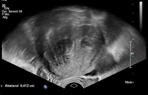 8 Transvaginal Ultrasound Image Of The Uterus Showing A Download