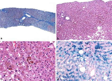 Liver Histology Shows Preserved Lobular Architecture With Mild Portal