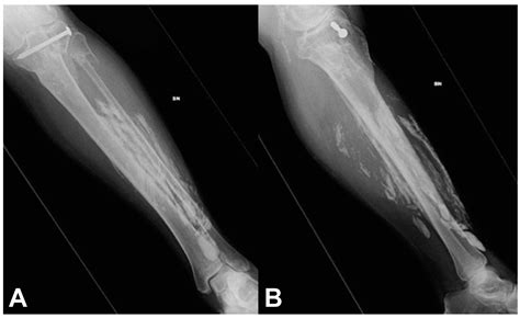 Medicina Free Full Text Calcific Myonecrosis Of The Leg A Rare Entity