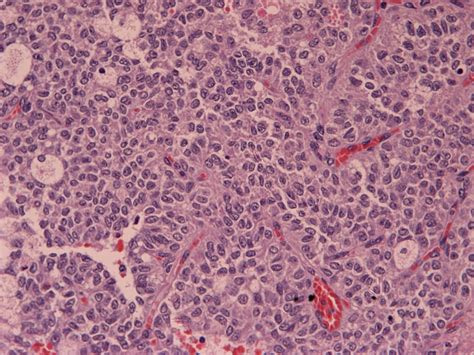 Solid Pseudopapillary Tumor Of The Pancreas Eurorad