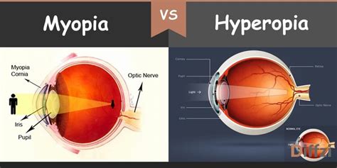 myopia vs hyperopia – Diffzi