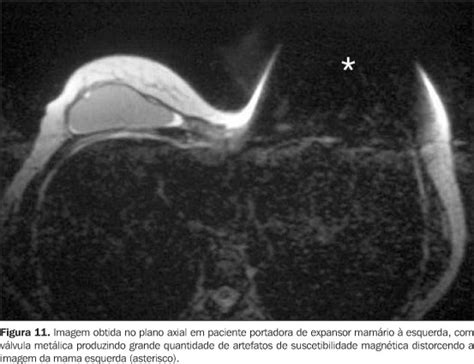Scielo Brasil Aspectos T Cnicos Da Resson Ncia Magn Tica De Mama