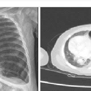 A Hyperinflated Left Lung With Mediastinal Shift Towards Right Side