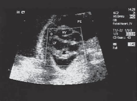 Figure 1 From Successful Outcome After Prenatal Treatment Of A Cardiac