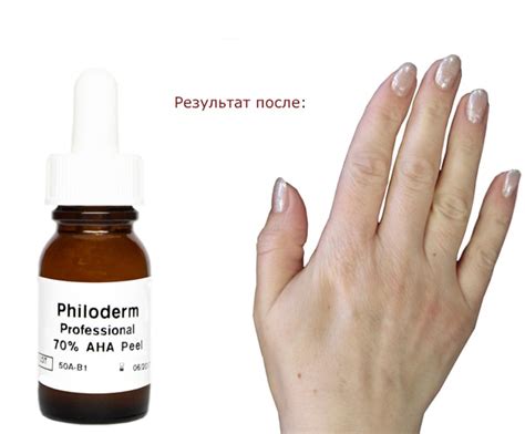 polza kislotnogo pilinga ruk philoderm evropeyskaya estetika ukraina