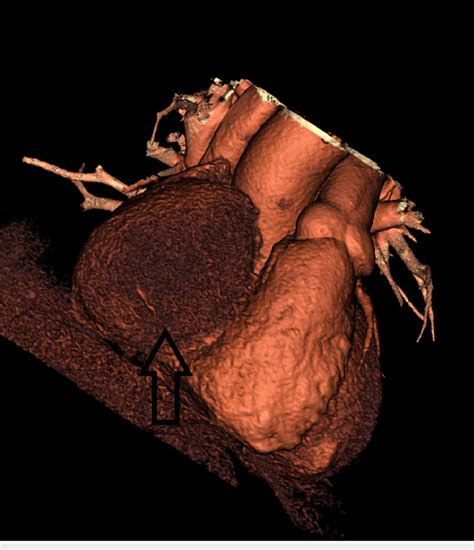 3D reconstructed CT heart with coronaries demonstrating the right ...