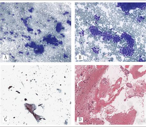 Scielo Brasil Cell Block Specimens Applied To Diagnostic Routine Of