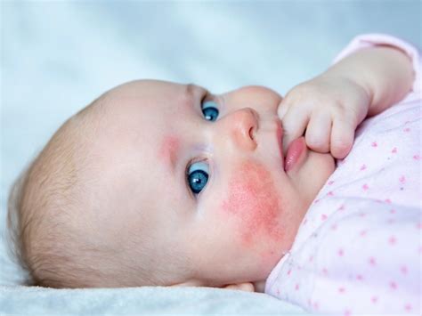 Understanding Common Newborn Rashes A Paediatricians Guide