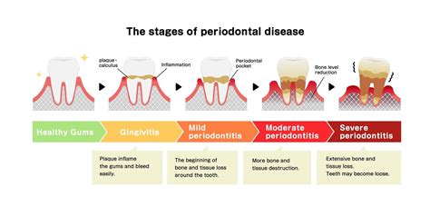 Healthy Gums Vs Unhealthy Gums Oral And Overall Health