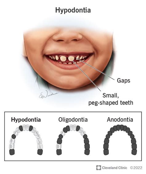 Hypodontia MEDizzy