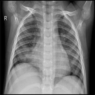 Chest X‐ray radiograph with Pneumonia | Download Scientific Diagram