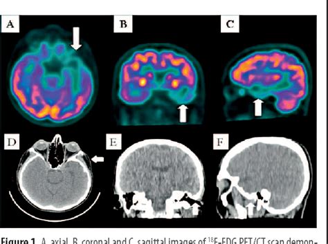 PDF 18 F FDG PET CT Findings In A Case Of A Semantic Variant Of