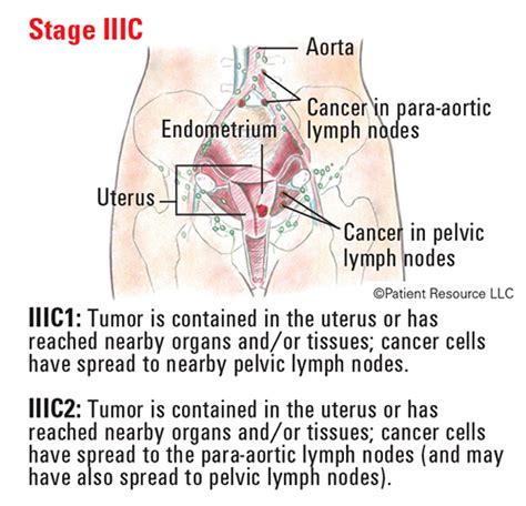 Uterine Cancer Staging