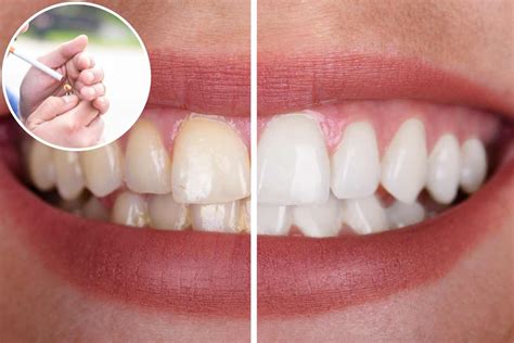 Denti Ingialliti Dal Fumo Ecco I Rimedi Semplicissimi Che Consigliano