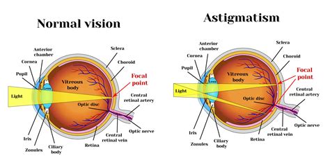 BatesEyeExercises.com === Astigmatism exercises