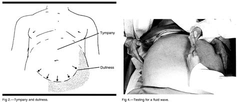 Ascites Fluid Wave Test: Why a hand on the abdomen? | Medicine Specifics