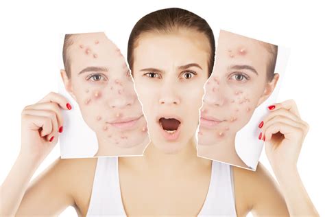 Treating Pimples Naturally. - Holistic Living Tips