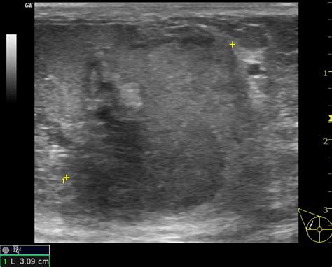 Breast Abscess Image Radiopaedia Org