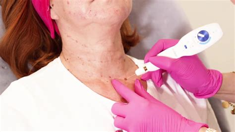 Laser Mole Removal By Maggie A Simple Procedure Using Laser