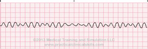 Acls Rhythm Identification Flashcards Quizlet