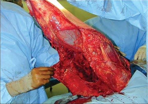 Degloving injury of the right leg that required defatting of the skin : r/MedicalGore