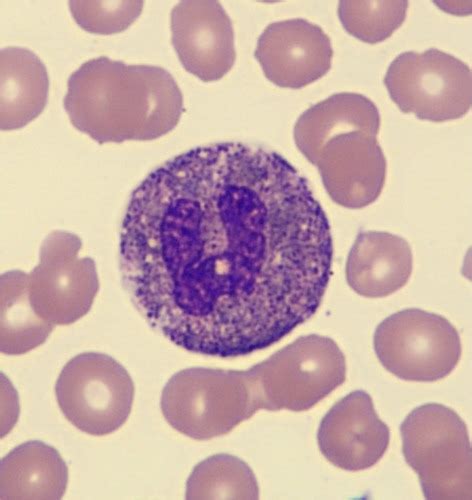 Leukocyte Abnormalities Neoplasms Flashcards Quizlet