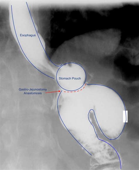 Roux En Y Gastric Bypass Upper Gi