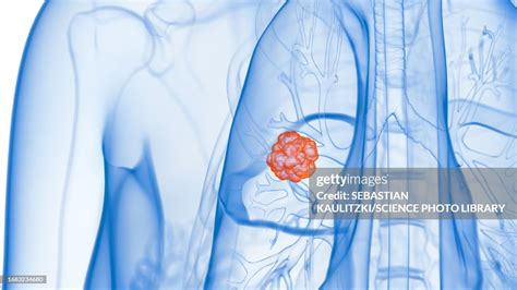 Lung Cancer Illustration High-Res Vector Graphic - Getty Images