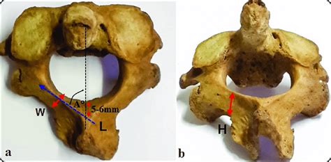 Axis Vertebra Superior View