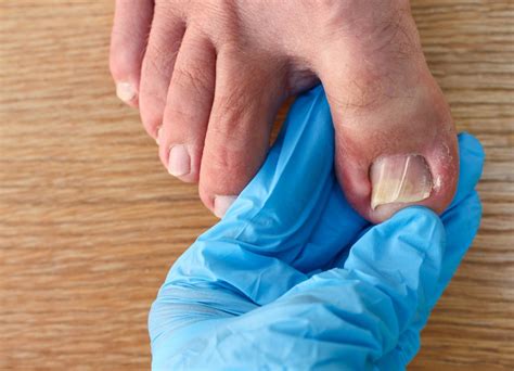 Ingrown Toenails Treatment Central Coast East Gosford Podiatry